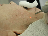 Применение лазеров при дермабразии в амбулаторных условиях