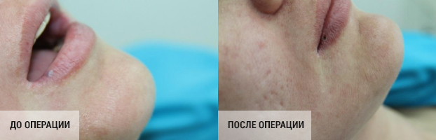 Диагноз - гемангиома нижней губы.