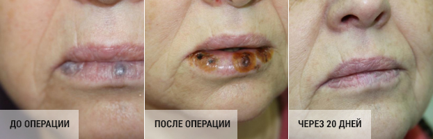 Диагноз - множественная старческая гемангиома нижней губы.