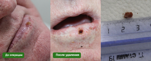 Кератомы и методы удаления диодным лазером.