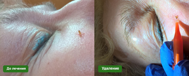 Кератомы и методы удаления диодным лазером.