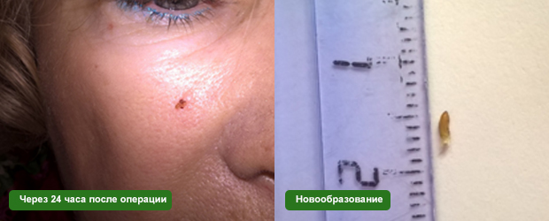 Кератомы и методы удаления диодным лазером.
