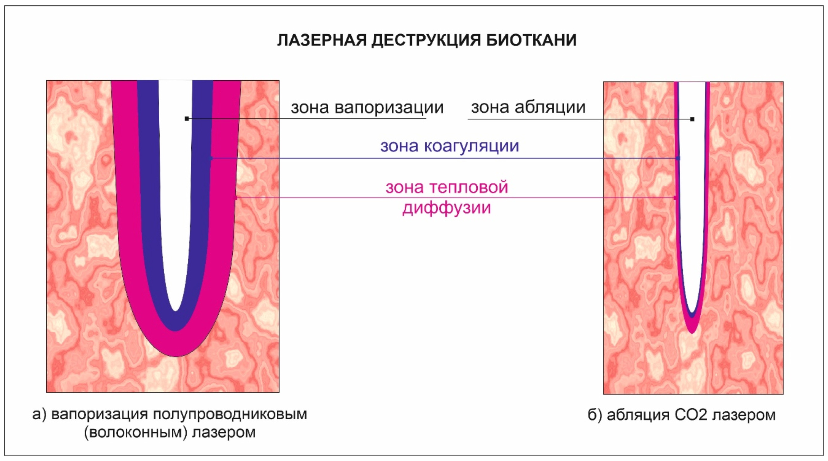 Сравнение воздействия лазеров