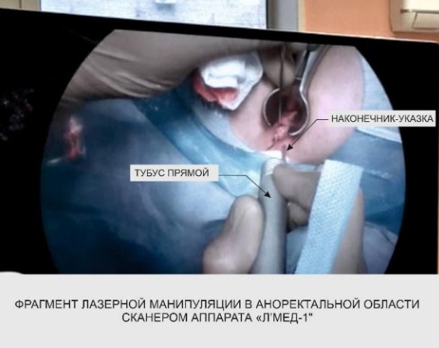позиционирование сканера аппарата Л’Мед-1 в операционном поле